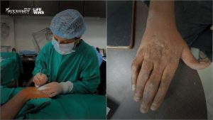 Doctors reconstruct crushed hand